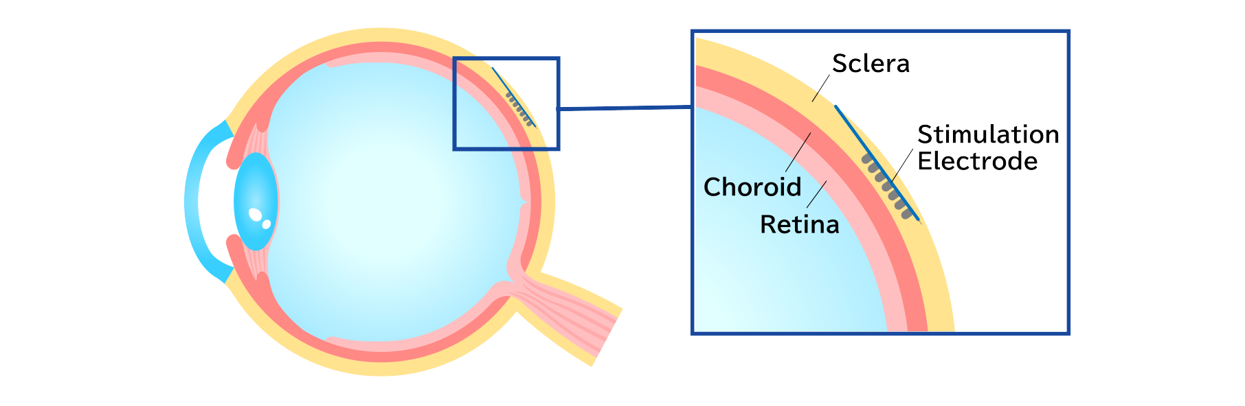 electrode implantation