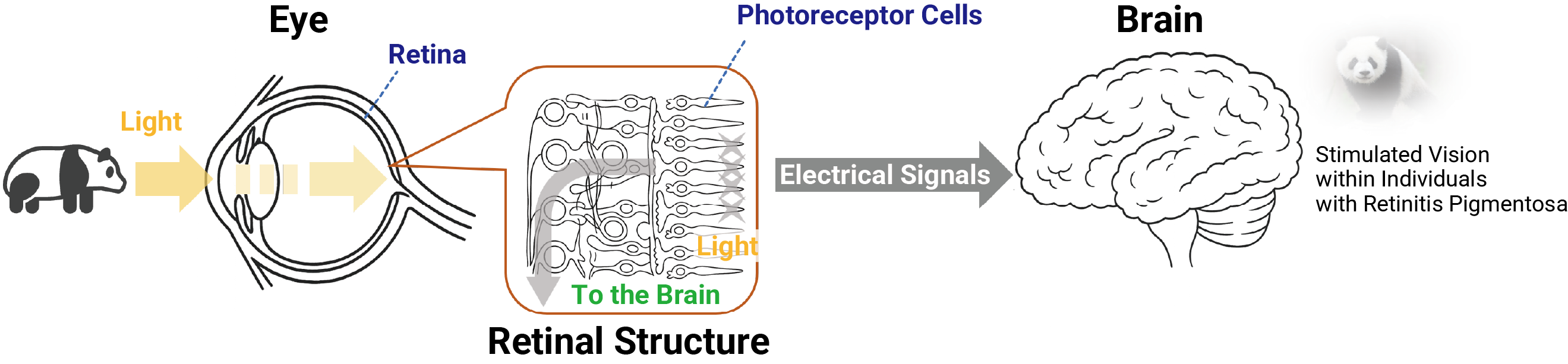 retinitis vision